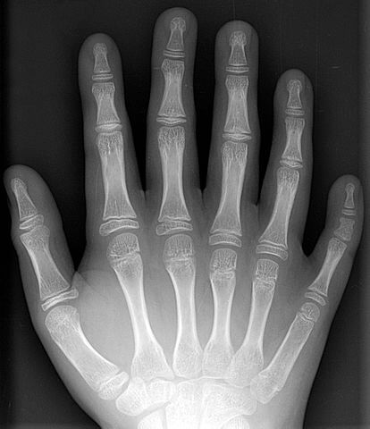 Radiografía de una mano con seis dedos